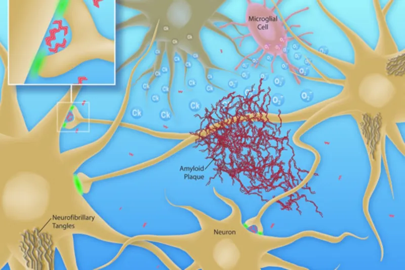 αλτσχαιμερ παθολογία νευρικών κυττάρων